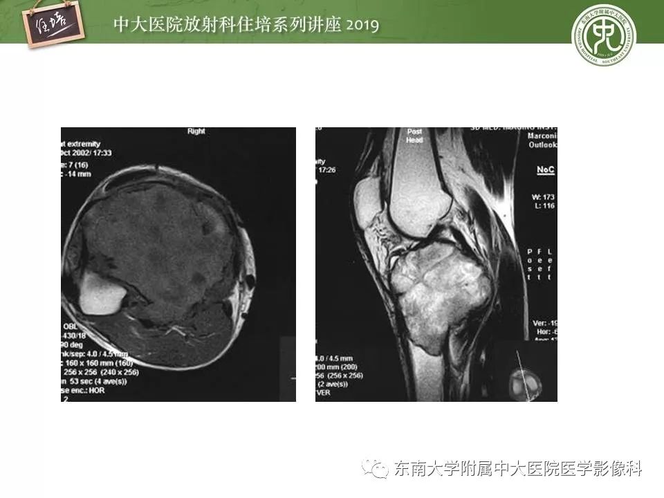 【PPT】常见良性骨肿瘤的影像诊断