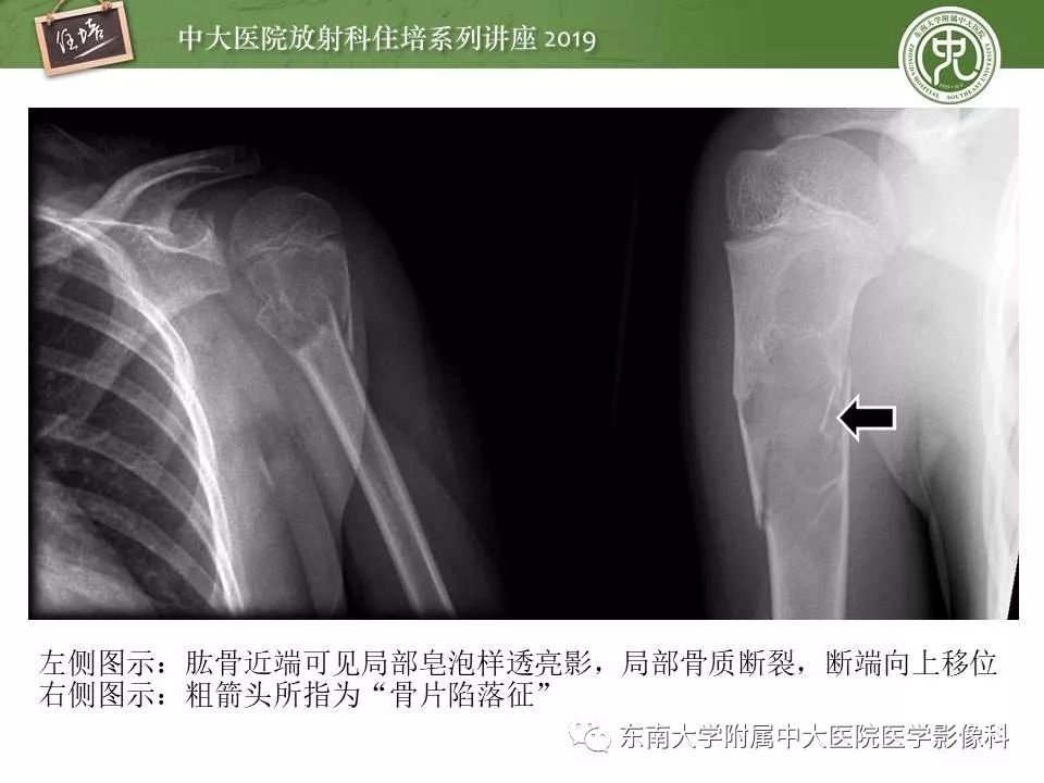 【PPT】常见良性骨肿瘤的影像诊断