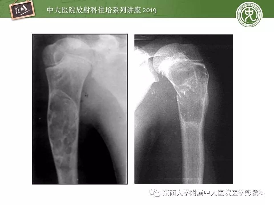 【PPT】常见良性骨肿瘤的影像诊断