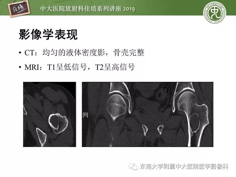 【PPT】常见良性骨肿瘤的影像诊断