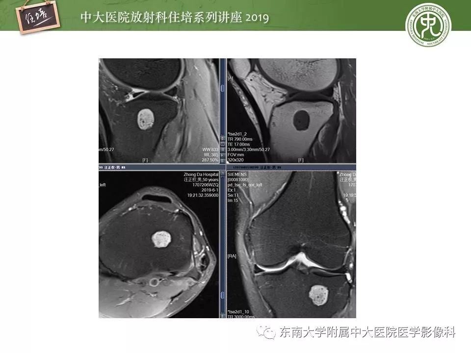 【PPT】常见良性骨肿瘤的影像诊断