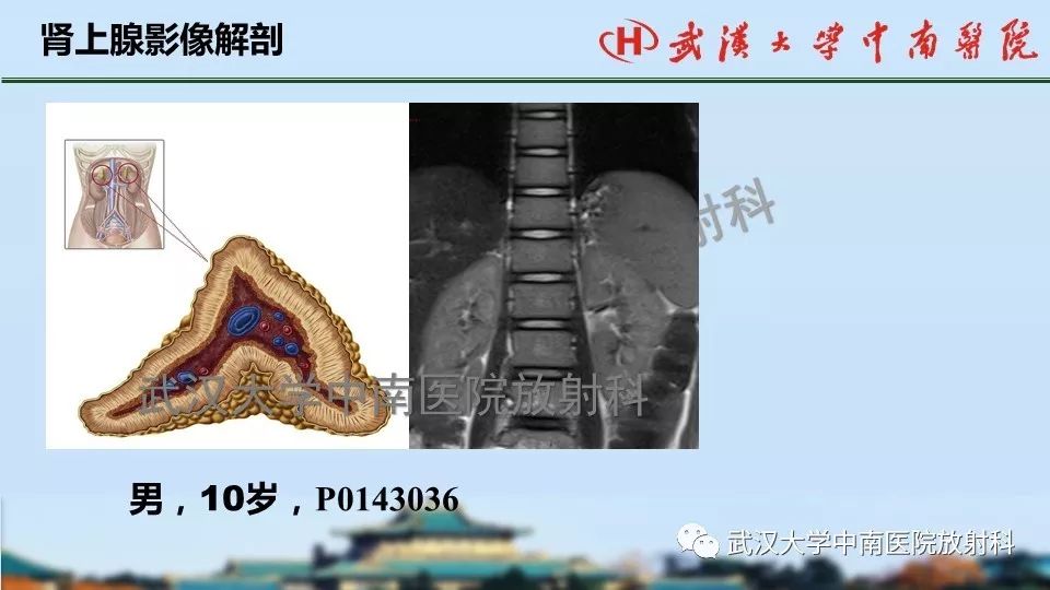 【PPT】肾上腺形态、功能及良恶性肿瘤CT影像诊断