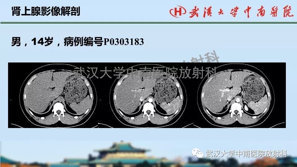 【PPT】肾上腺形态、功能及良恶性肿瘤CT影像诊断