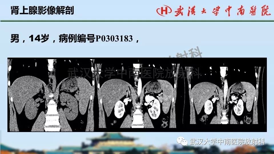 【PPT】肾上腺形态、功能及良恶性肿瘤CT影像诊断