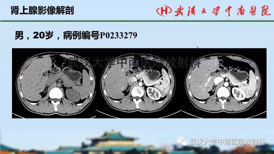 【PPT】肾上腺形态、功能及良恶性肿瘤CT影像诊断
