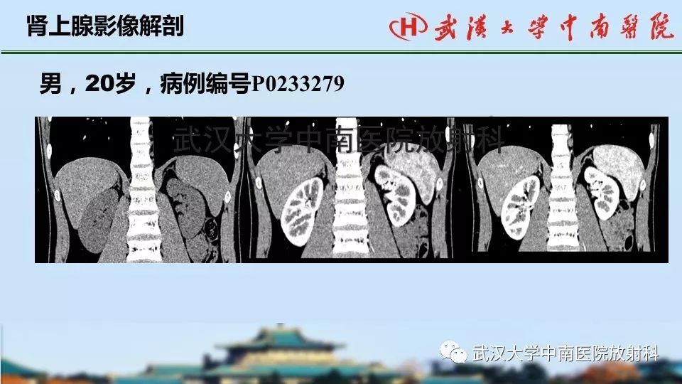 【PPT】肾上腺形态、功能及良恶性肿瘤CT影像诊断