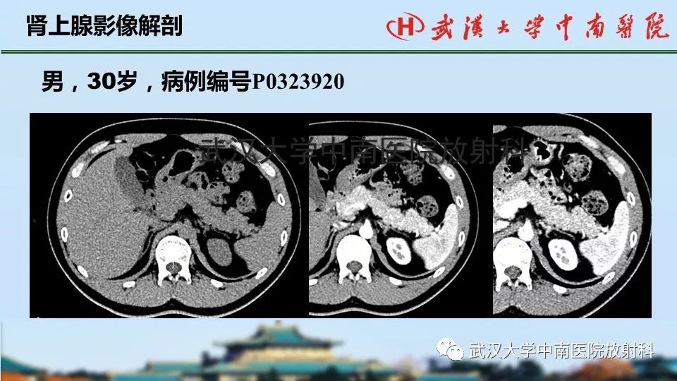 【PPT】肾上腺形态、功能及良恶性肿瘤CT影像诊断