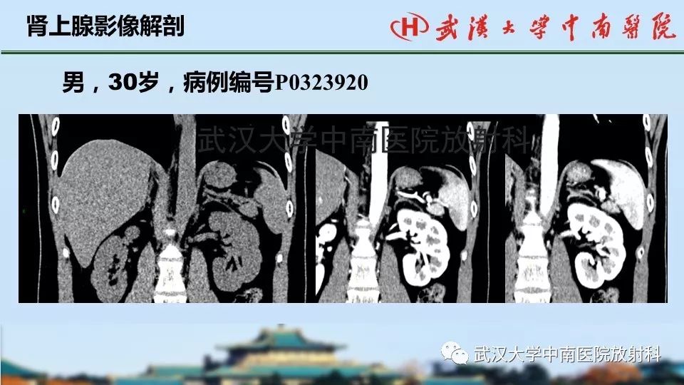 【PPT】肾上腺形态、功能及良恶性肿瘤CT影像诊断