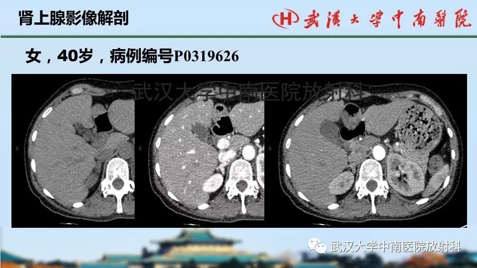 【PPT】肾上腺形态、功能及良恶性肿瘤CT影像诊断