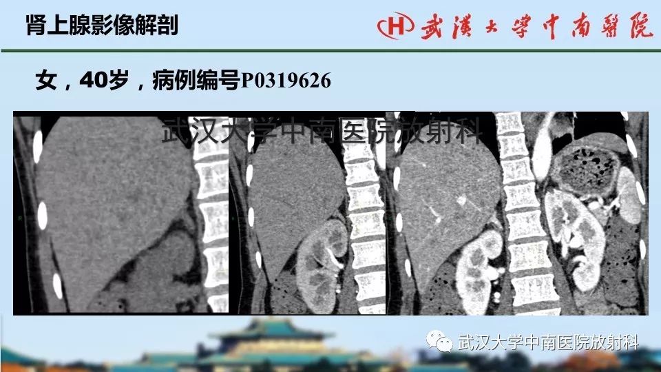 【PPT】肾上腺形态、功能及良恶性肿瘤CT影像诊断