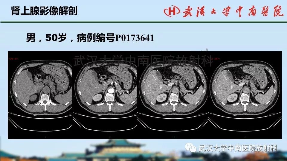 【PPT】肾上腺形态、功能及良恶性肿瘤CT影像诊断