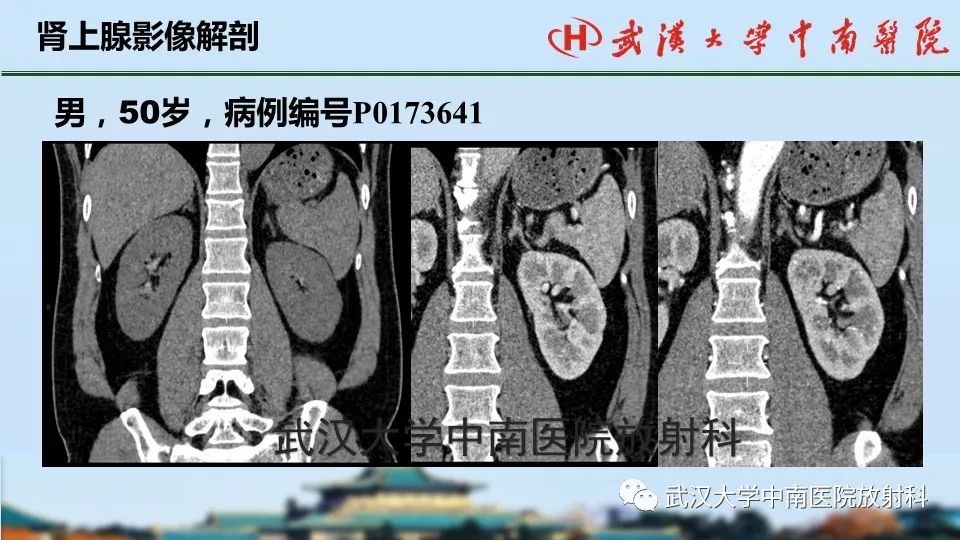 【PPT】肾上腺形态、功能及良恶性肿瘤CT影像诊断