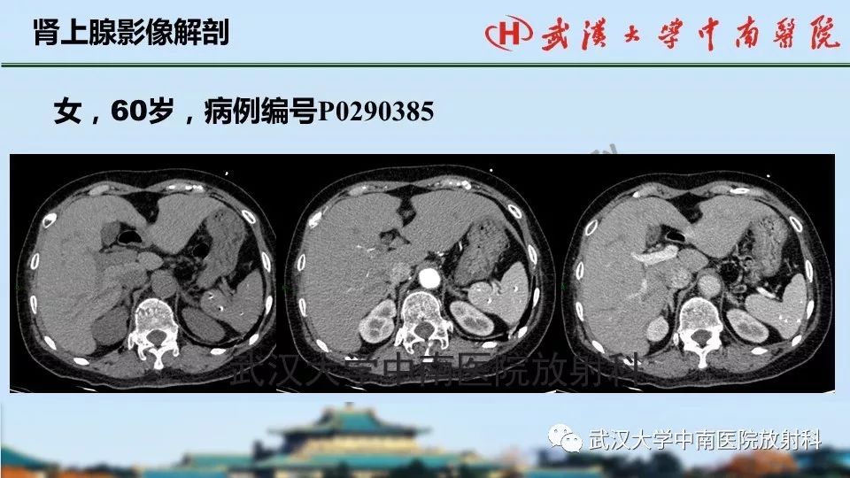 【PPT】肾上腺形态、功能及良恶性肿瘤CT影像诊断