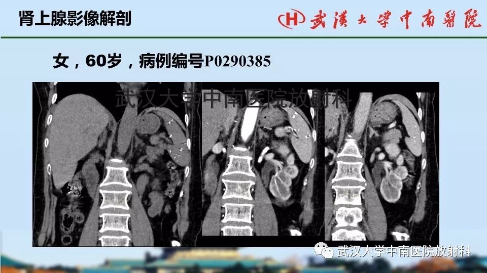 【PPT】肾上腺形态、功能及良恶性肿瘤CT影像诊断