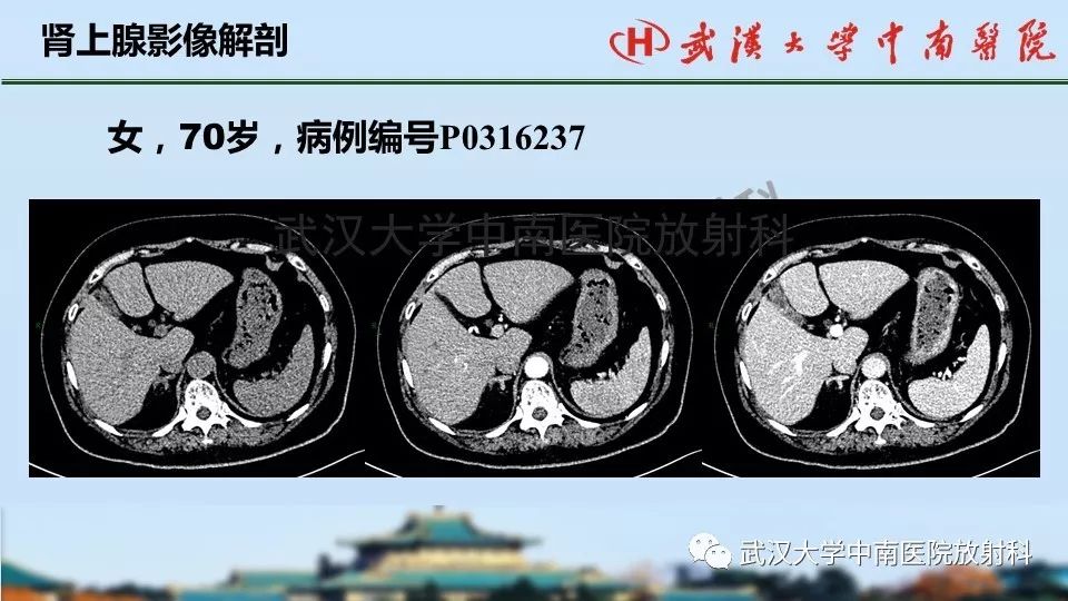 【PPT】肾上腺形态、功能及良恶性肿瘤CT影像诊断