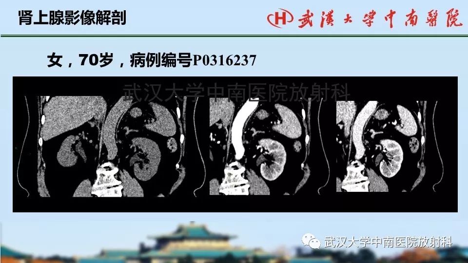 【PPT】肾上腺形态、功能及良恶性肿瘤CT影像诊断