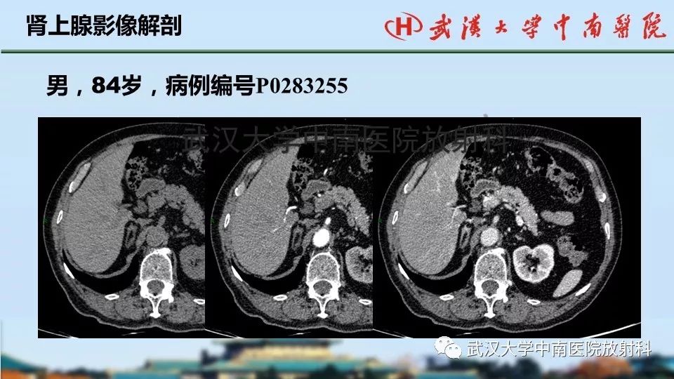 【PPT】肾上腺形态、功能及良恶性肿瘤CT影像诊断