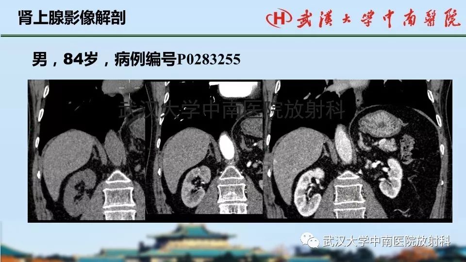 【PPT】肾上腺形态、功能及良恶性肿瘤CT影像诊断