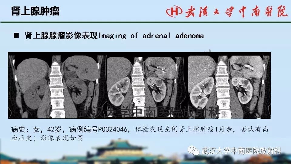 【PPT】肾上腺形态、功能及良恶性肿瘤CT影像诊断