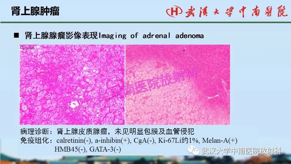 【PPT】肾上腺形态、功能及良恶性肿瘤CT影像诊断