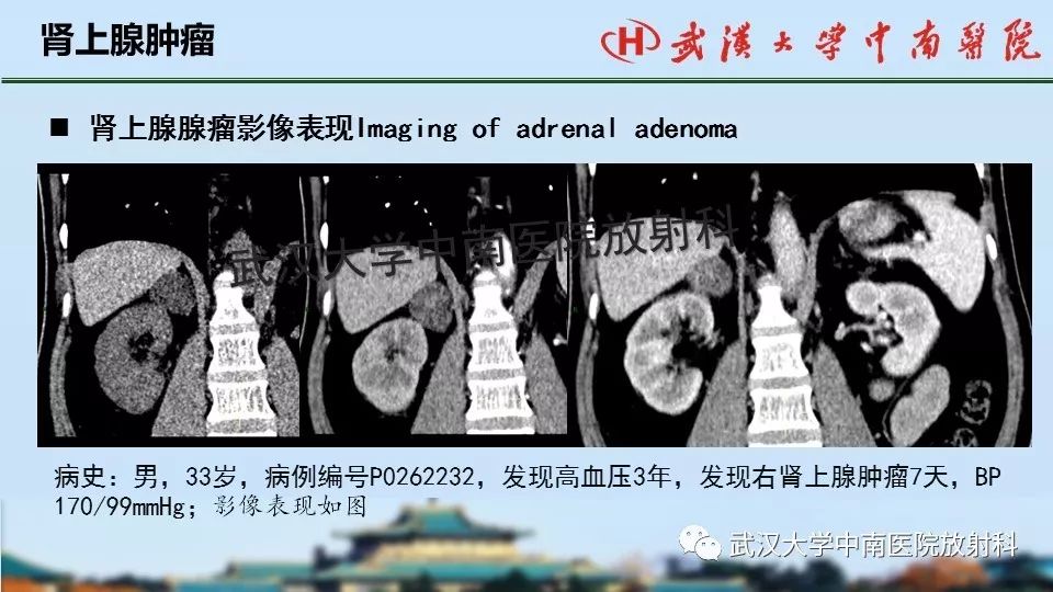 【PPT】肾上腺形态、功能及良恶性肿瘤CT影像诊断