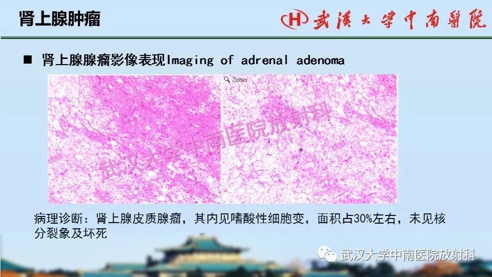 【PPT】肾上腺形态、功能及良恶性肿瘤CT影像诊断