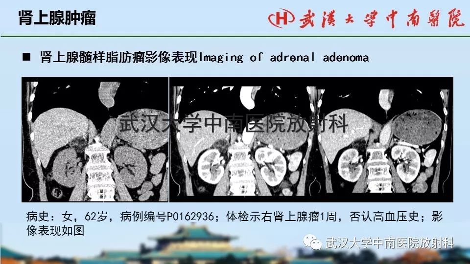 【PPT】肾上腺形态、功能及良恶性肿瘤CT影像诊断