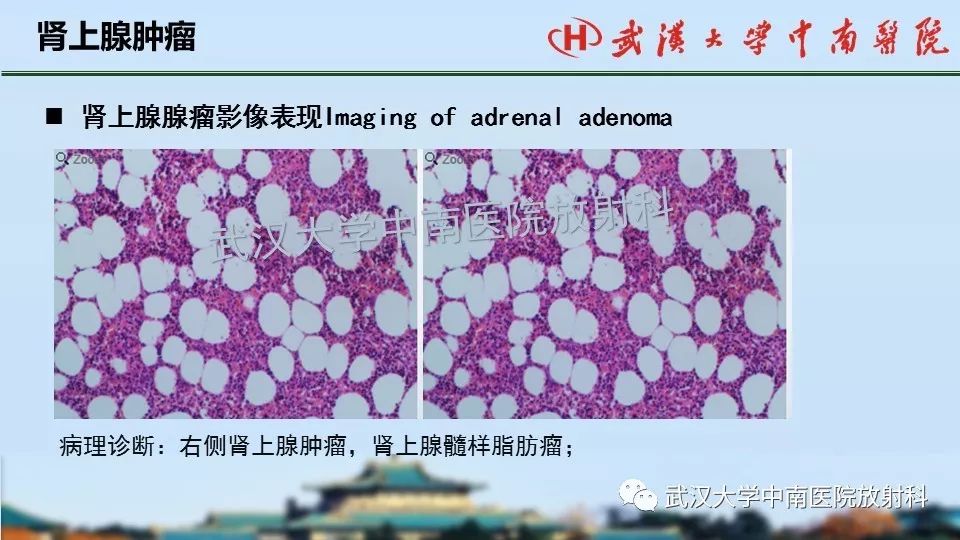 【PPT】肾上腺形态、功能及良恶性肿瘤CT影像诊断