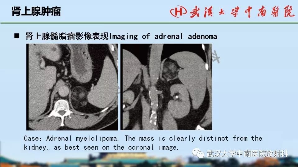 【PPT】肾上腺形态、功能及良恶性肿瘤CT影像诊断