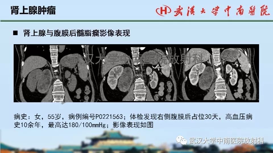 【PPT】肾上腺形态、功能及良恶性肿瘤CT影像诊断