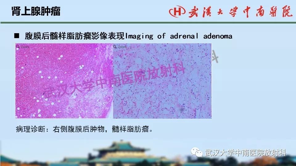 【PPT】肾上腺形态、功能及良恶性肿瘤CT影像诊断