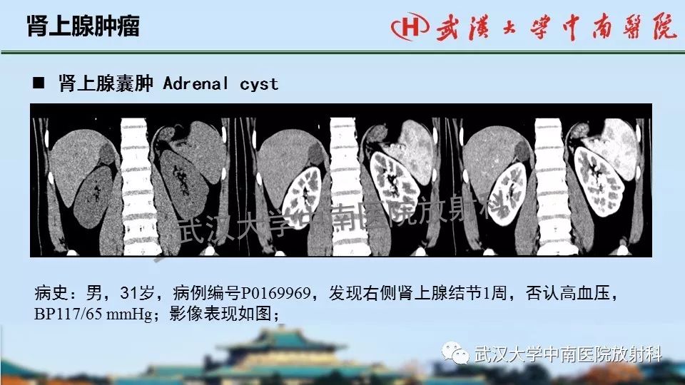 【PPT】肾上腺形态、功能及良恶性肿瘤CT影像诊断