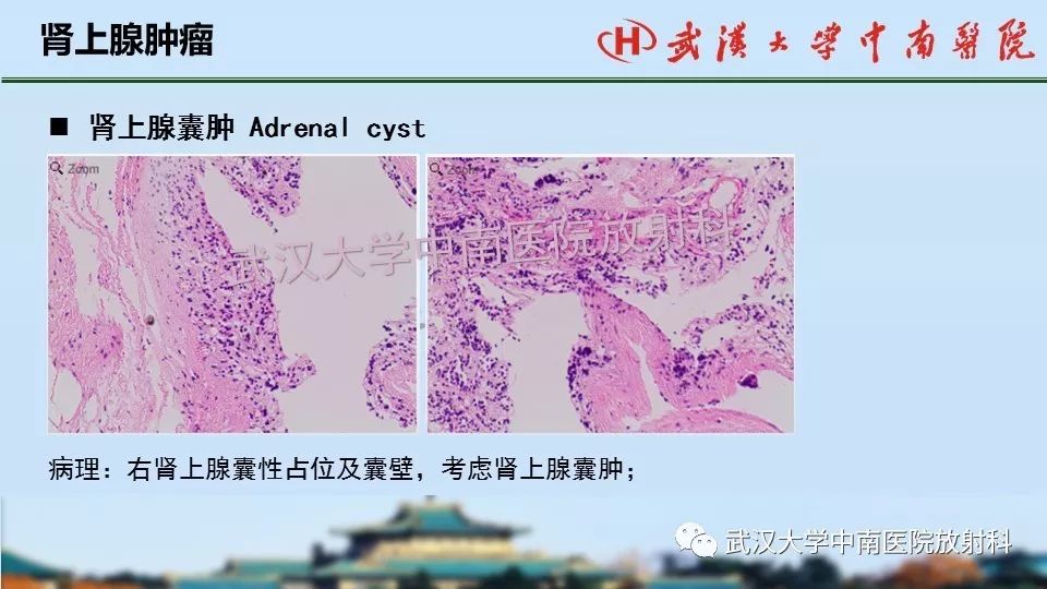 【PPT】肾上腺形态、功能及良恶性肿瘤CT影像诊断