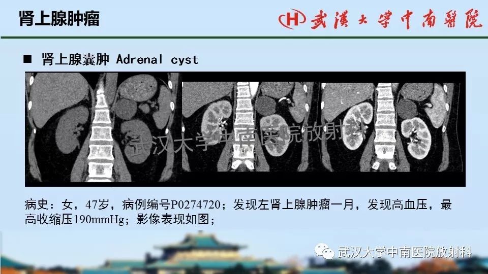 【PPT】肾上腺形态、功能及良恶性肿瘤CT影像诊断