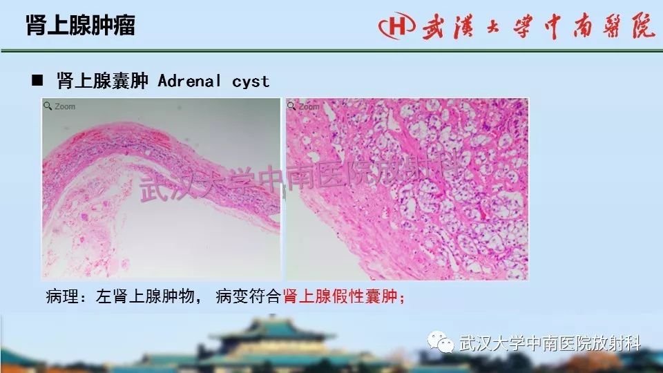 【PPT】肾上腺形态、功能及良恶性肿瘤CT影像诊断