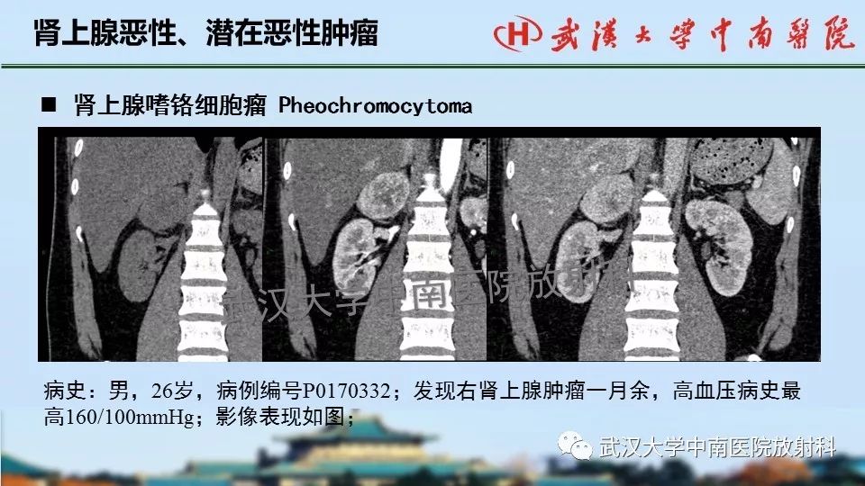【PPT】肾上腺形态、功能及良恶性肿瘤CT影像诊断