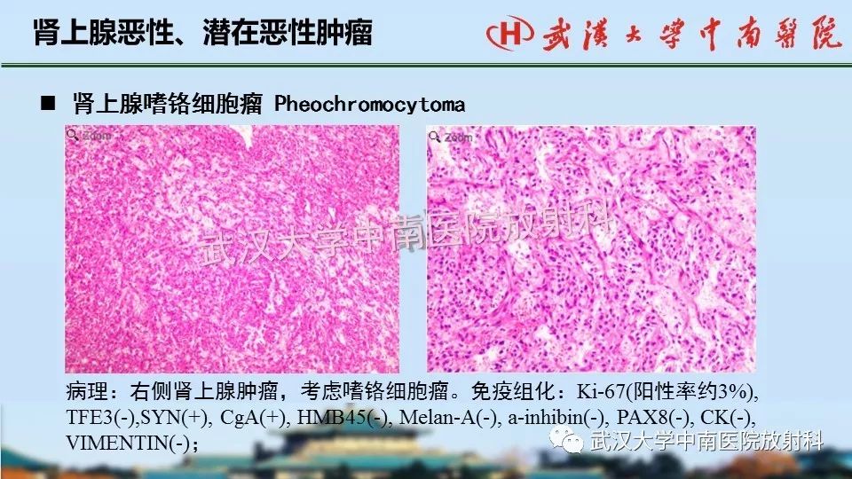 【PPT】肾上腺形态、功能及良恶性肿瘤CT影像诊断