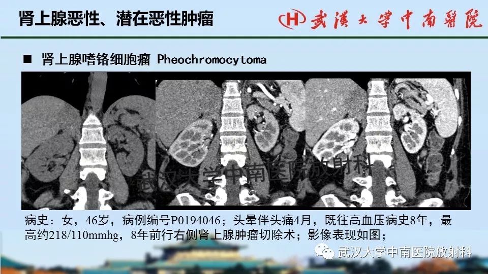 【PPT】肾上腺形态、功能及良恶性肿瘤CT影像诊断
