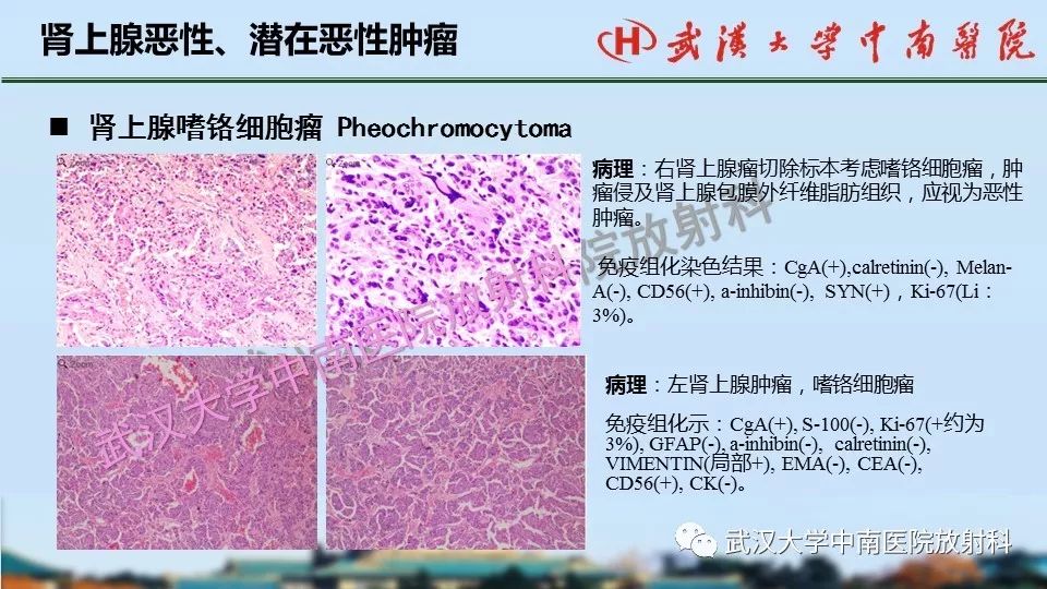 【PPT】肾上腺形态、功能及良恶性肿瘤CT影像诊断