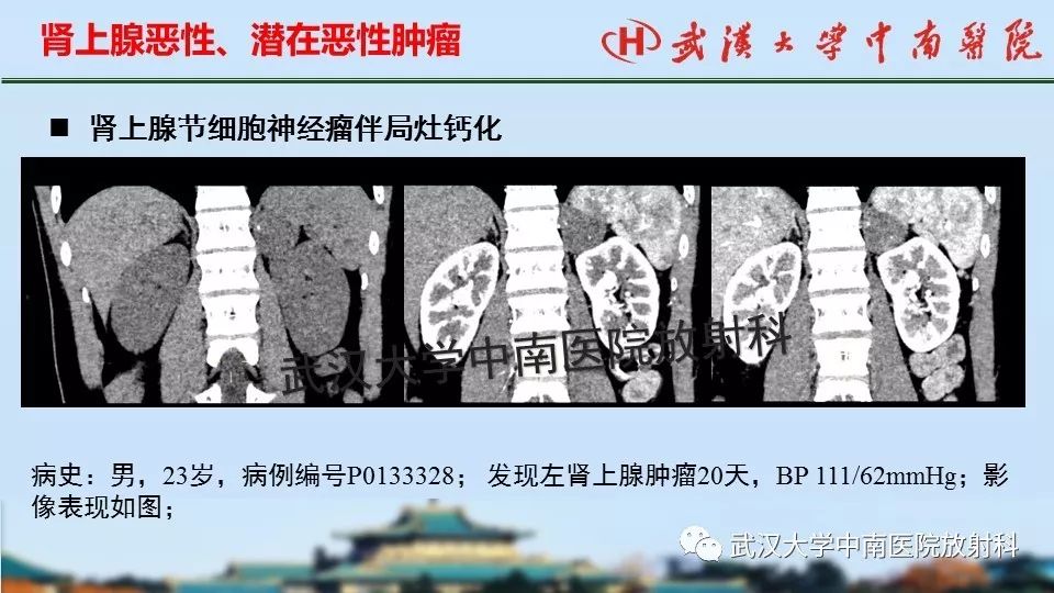 【PPT】肾上腺形态、功能及良恶性肿瘤CT影像诊断