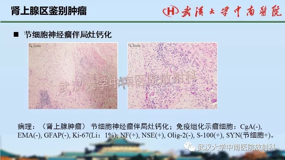 【PPT】肾上腺形态、功能及良恶性肿瘤CT影像诊断
