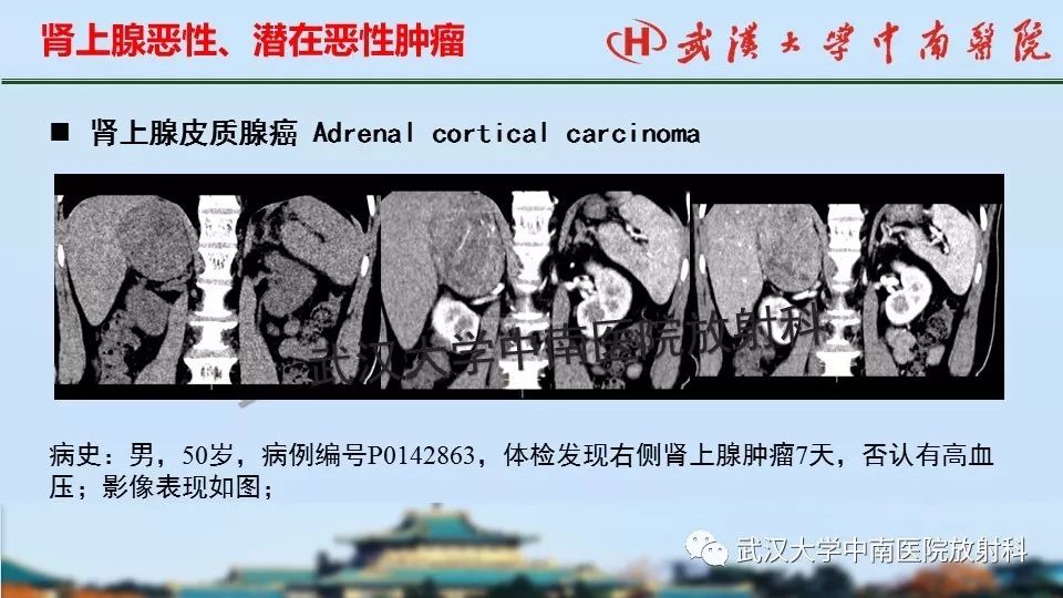 【PPT】肾上腺形态、功能及良恶性肿瘤CT影像诊断