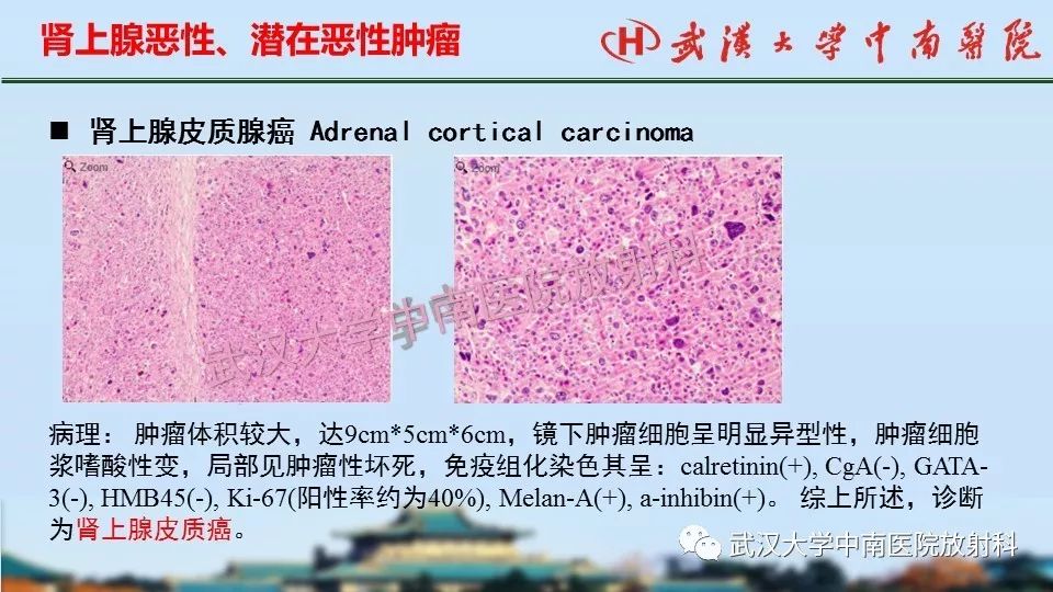 【PPT】肾上腺形态、功能及良恶性肿瘤CT影像诊断