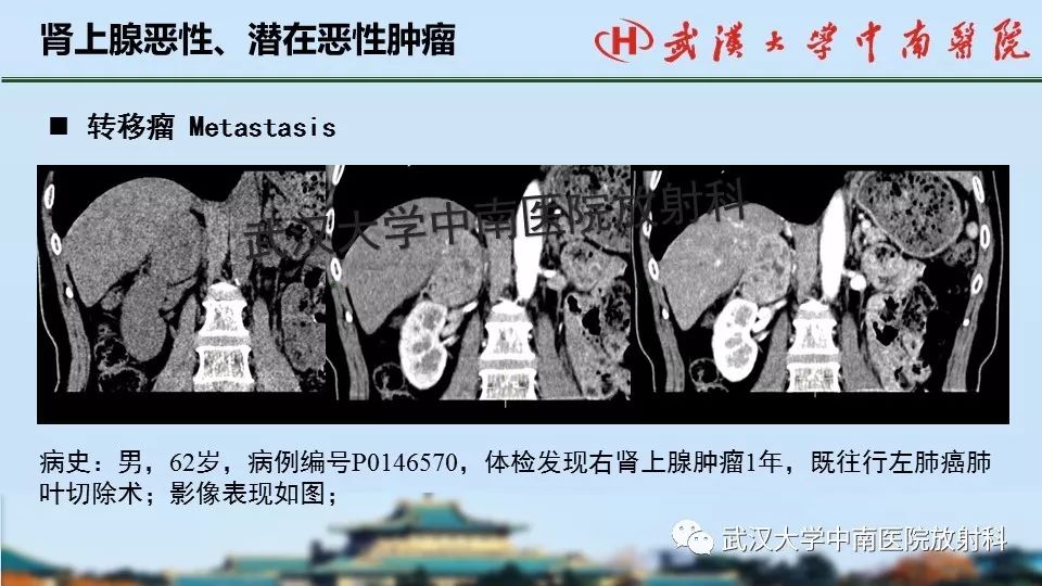 【PPT】肾上腺形态、功能及良恶性肿瘤CT影像诊断