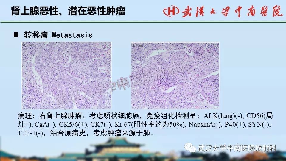 【PPT】肾上腺形态、功能及良恶性肿瘤CT影像诊断