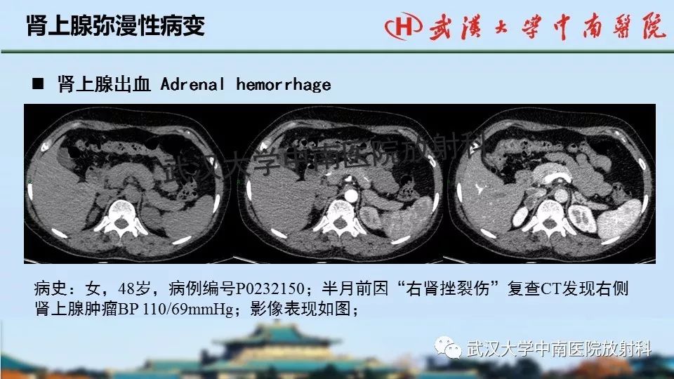 【PPT】肾上腺形态、功能及良恶性肿瘤CT影像诊断