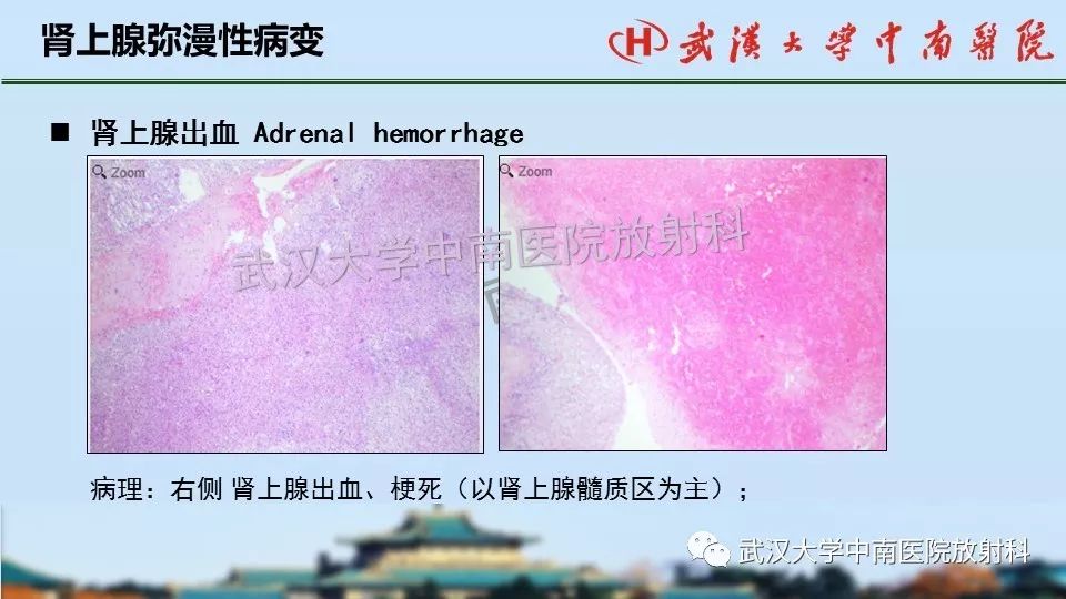 【PPT】肾上腺形态、功能及良恶性肿瘤CT影像诊断