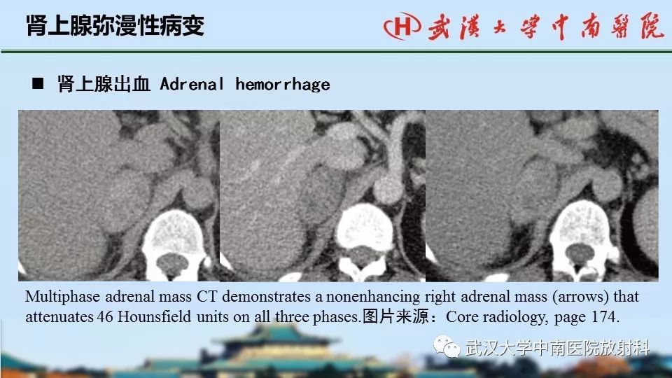【PPT】肾上腺形态、功能及良恶性肿瘤CT影像诊断