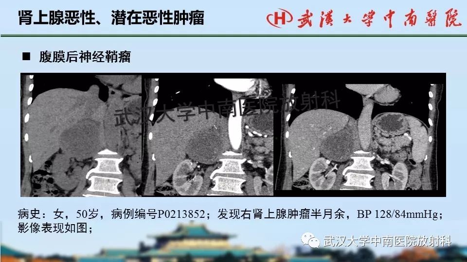 【PPT】肾上腺形态、功能及良恶性肿瘤CT影像诊断