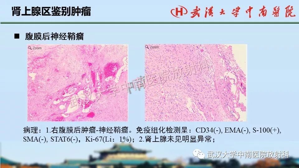 【PPT】肾上腺形态、功能及良恶性肿瘤CT影像诊断